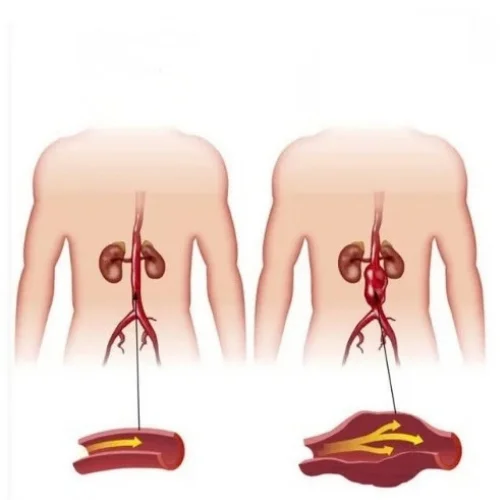 Aortic Interventions