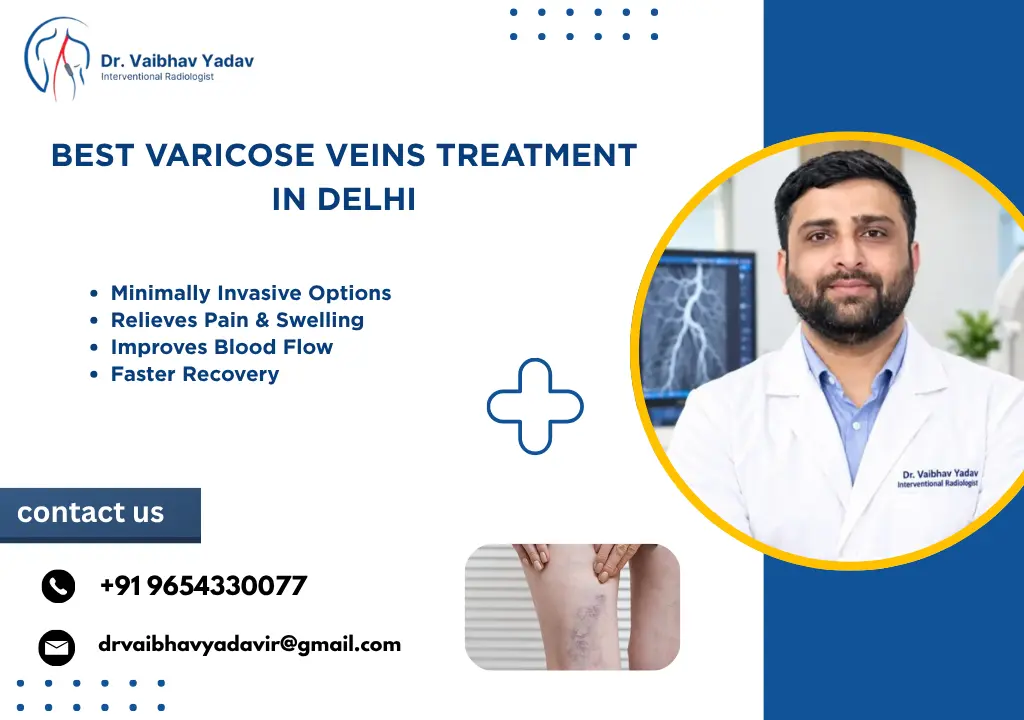 Best Varicose Veins Treatment in Delhi