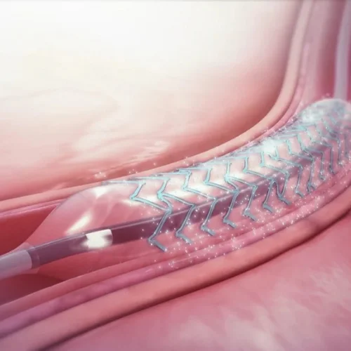 Endovascular Treatment
