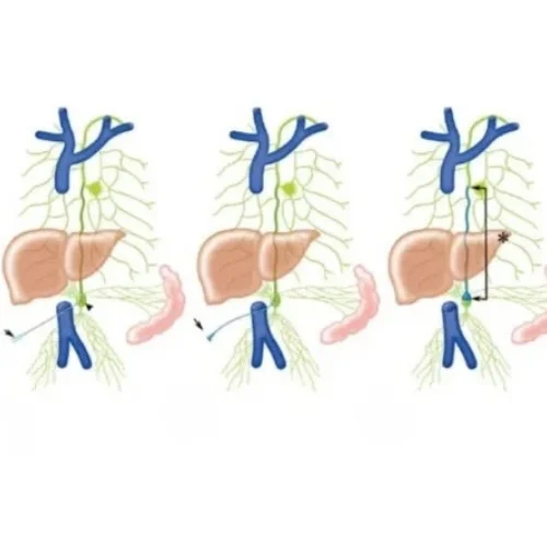 Lymphatic Interventions