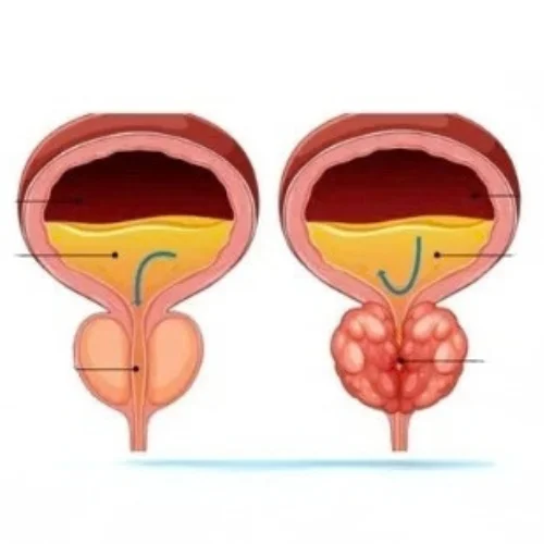 Prostatic Artery Embolization