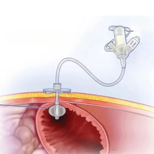 Radiologically Inserted Gastrostomy