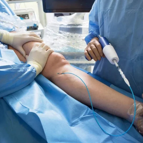 Varicose Vein Glue Therapy