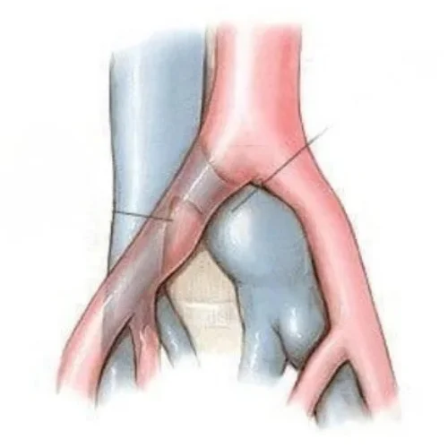 Venoplasty & Stenting